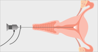 Hysteroscopy